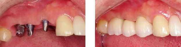 Implant crowns replacing missing back teeth
