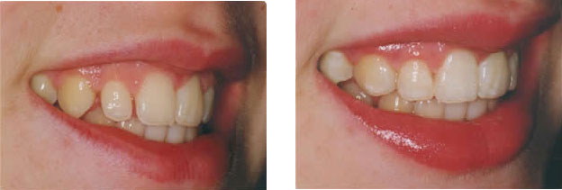 Bonding used to close spaces and improve tooth shape.