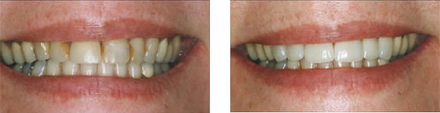 Porcelain crowns used to repair large fillings and strengthen front teeth