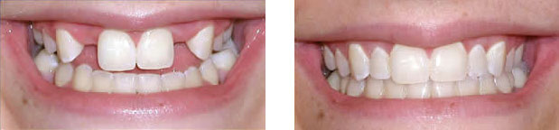 Implant crowns replacing congenitally missing teeth
