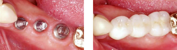 Implant crowns to restore function and increase chewing ability.