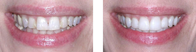 Porcelain veneers correcting tooth color and stained fillings