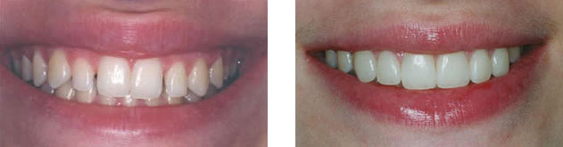 Porcelain veneers closing spaces and improving tooth shape